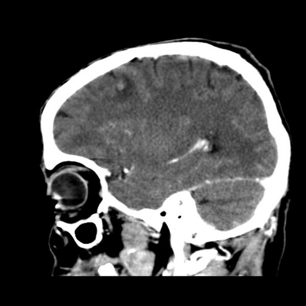 File:Brain metastases from lung cancer (Radiopaedia 24480-24781 C+ delayed 41).jpg