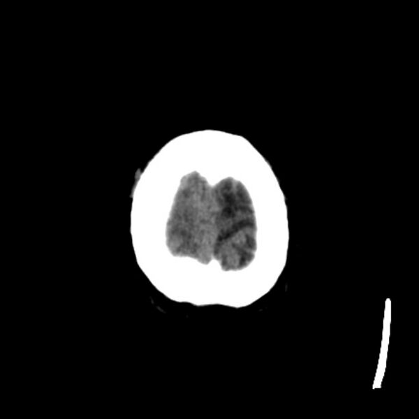File:Brain metastases from lung cancer (Radiopaedia 27849-28092 Axial non-contrast 44).jpg
