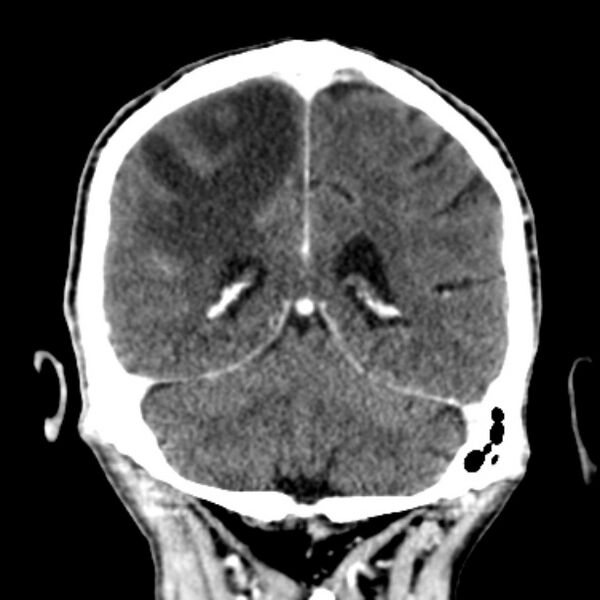 File:Brain metastases from lung cancer (Radiopaedia 27849-28092 Coronal C+ delayed 47).jpg