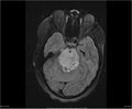 Brainstem glioma (Radiopaedia 21819-21775 Axial FLAIR 13).jpg