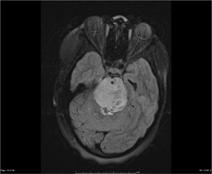 File:Brainstem glioma (Radiopaedia 21819-21775 Axial FLAIR 13).jpg