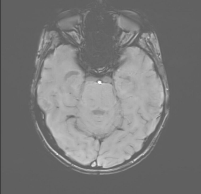 Brainstem glioma (Radiopaedia 70548-80674 Axial SWI 19).jpg
