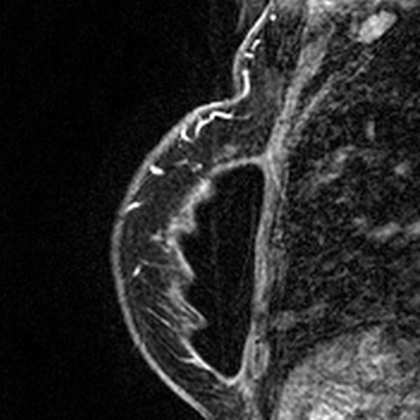 File:Breast implants - MRI (Radiopaedia 26864-27035 Sagittal T2 87).jpg