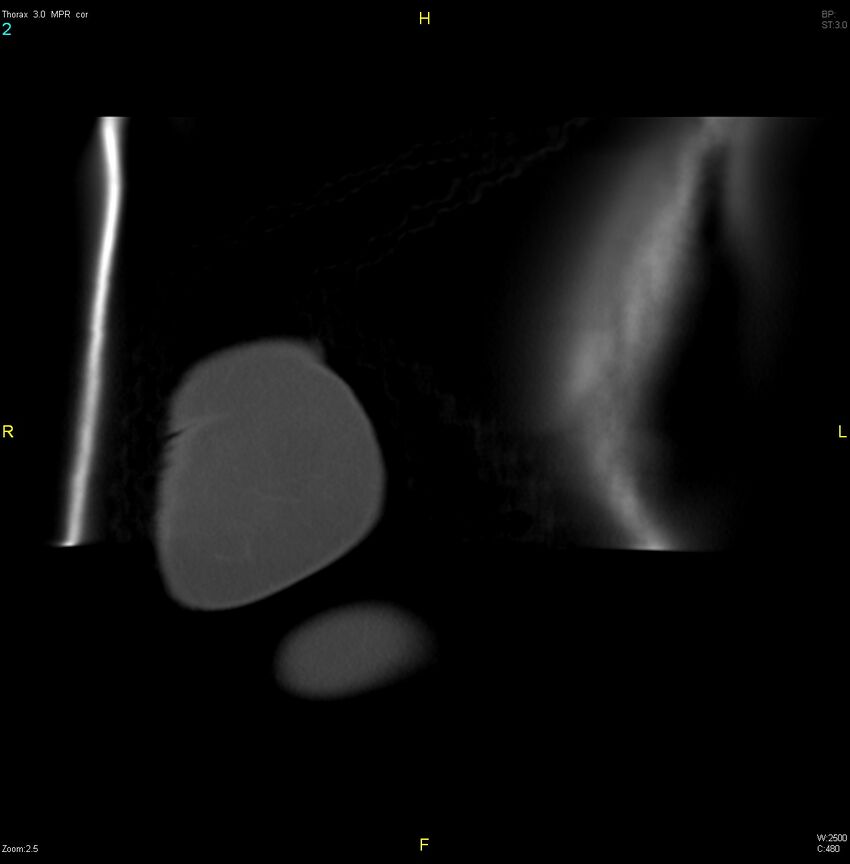 Breast primary with lung and bone metastases (Radiopaedia 40620-43228 bone window 2).jpg