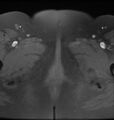 Broad ligament leiomyoma (Radiopaedia 81634-95516 Axial T1 fat sat 30).jpg