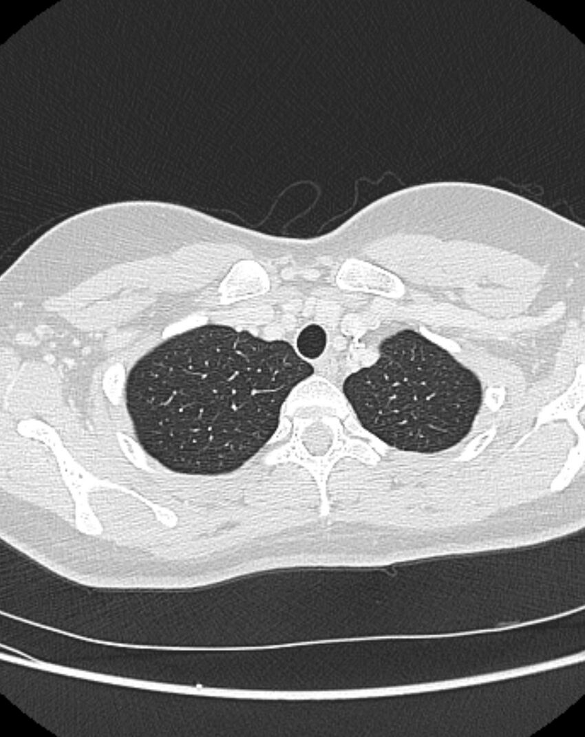 Bronchial atresia (Radiopaedia 50007-55297 Axial lung window 11).jpg
