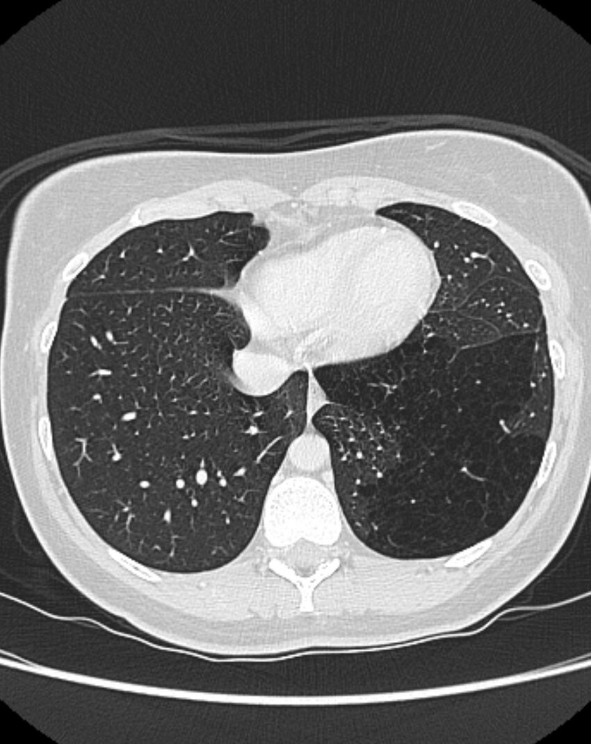 Bronchial atresia (Radiopaedia 50007-55297 Axial lung window 83).jpg