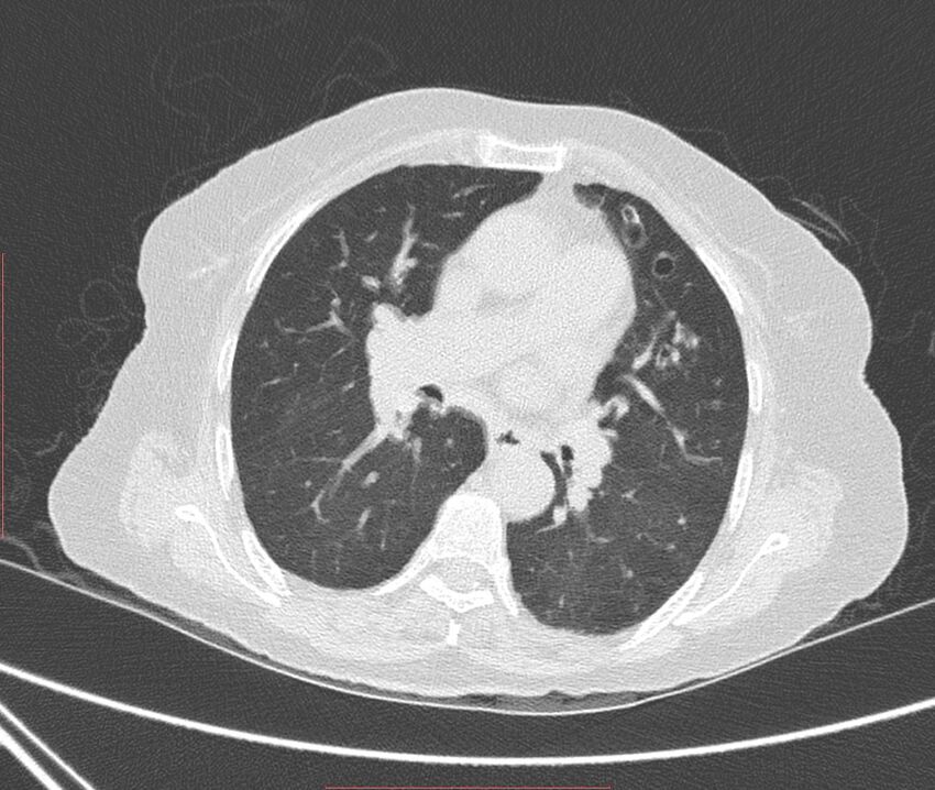 Bronchiectasis (Radiopaedia 72693-83293 Axial lung window 64).jpg