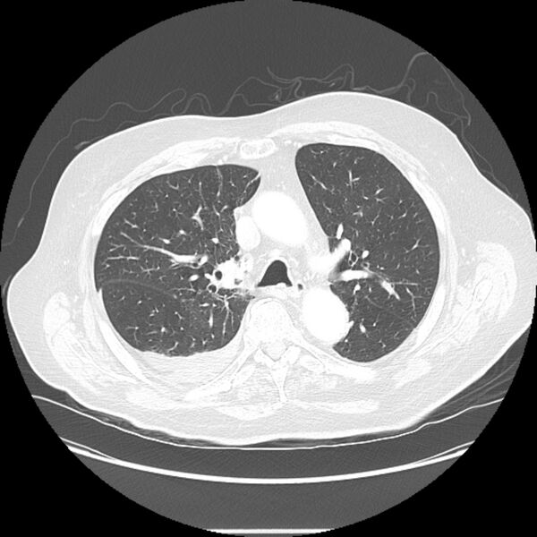 File:Bronchogenic adenocarcinoma and pulmonary embolism (Radiopaedia 9097-9806 Axial lung window 11).jpg