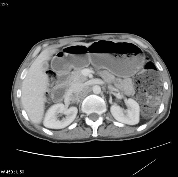 File:Bronchogenic carcinoma (Radiopaedia 8857-9645 A 21).jpg