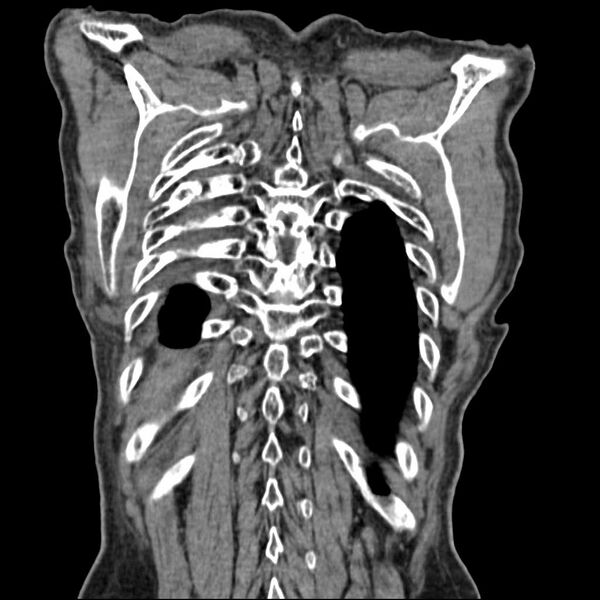 File:Bronchopleural fistula - postoperative complication (Radiopaedia 21020-20947 Coronal non-contrast 26).jpg