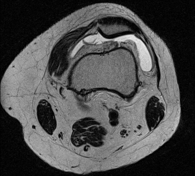 File:Bucket handle tear - medial meniscus (Radiopaedia 79028-91942 Axial T2 24).jpg