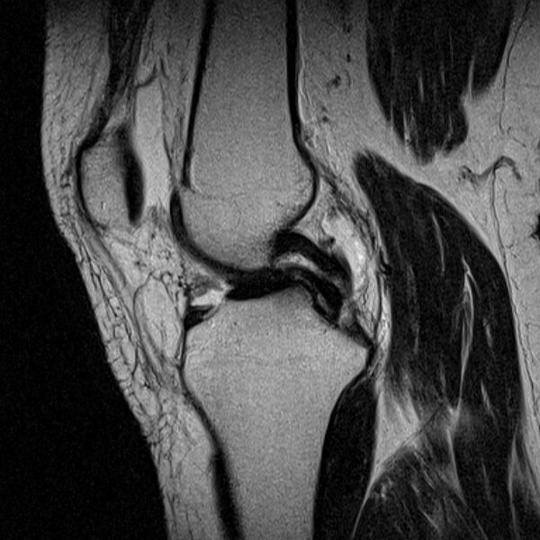 File:Bucket handle tear - medial meniscus (Radiopaedia 79028-91942 Sagittal T2 14).jpg