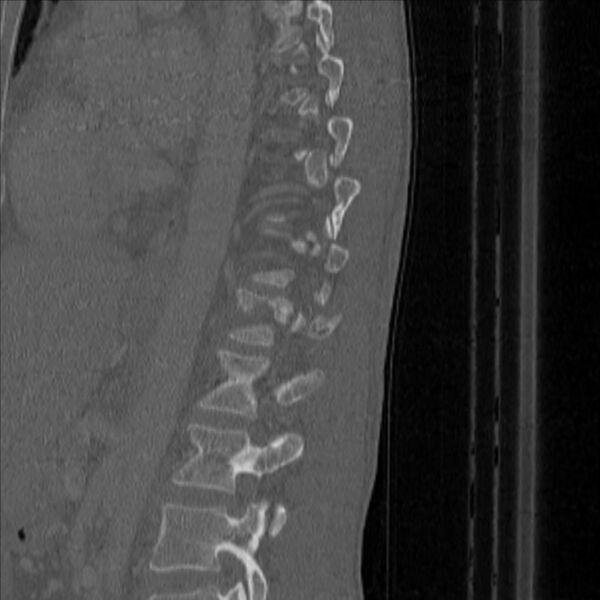 File:Bulging of paraspinal line in traumatic thoracal spinal compression fracture (Radiopaedia 29221-35872 Sagittal bone window 43).jpg