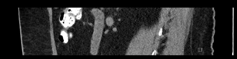 File:Buried bumper syndrome - gastrostomy tube (Radiopaedia 63843-72575 Sagittal Inject 77).jpg