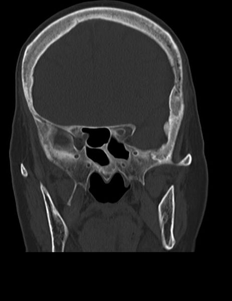 File:Burnt-out meningioma (Radiopaedia 51557-57337 Coronal bone window 18).jpg