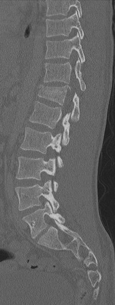 File:Burst fracture - T12 with conus compression (Radiopaedia 56825-63647 Sagittal bone window 34).png