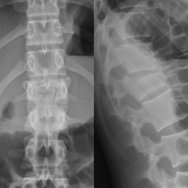 File:Burst lumbar fracture (Radiopaedia 4635-6717 AP & Lateral 1).jpg