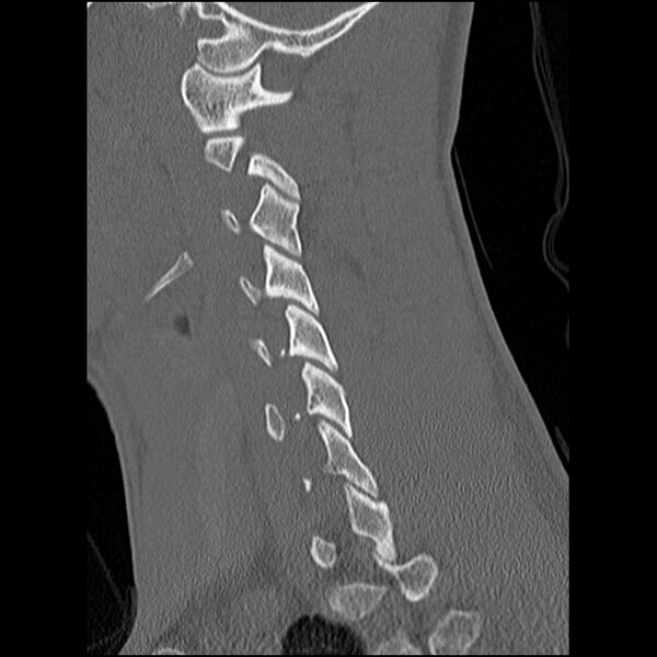 File:C5 facet fracture (Radiopaedia 58374-65499 Sagittal bone window 47).jpg