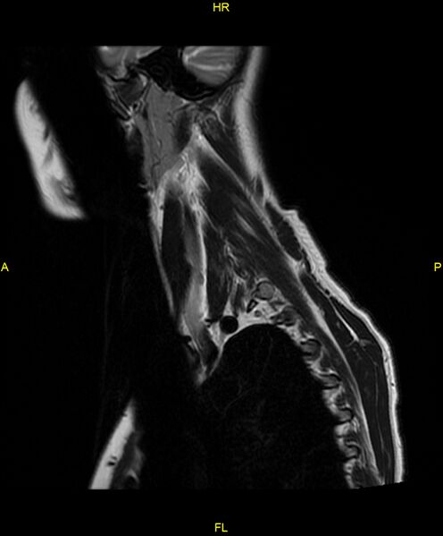 File:C5 nerve sheath tumor (Radiopaedia 85777-101596 Sagittal T2 3).jpg