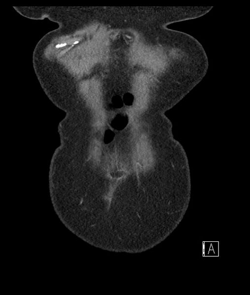 File:Calcified adrenal glands and Spigelian hernia (Radiopaedia 49741-54988 B 9).jpg
