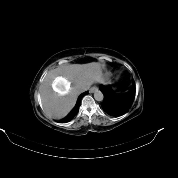File:Calcified hydatid cyst (Radiopaedia 62000-70085 Axial non-contrast 23).jpg
