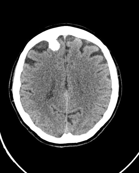 File:Calcified meningioma (Radiopaedia 74361-85243 Axial non-contrast 19).jpg