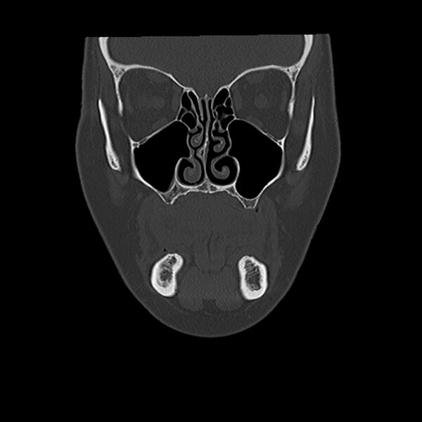 File:Canal up mastoidectomy (Radiopaedia 78108-90638 Coronal bone window 6).jpg