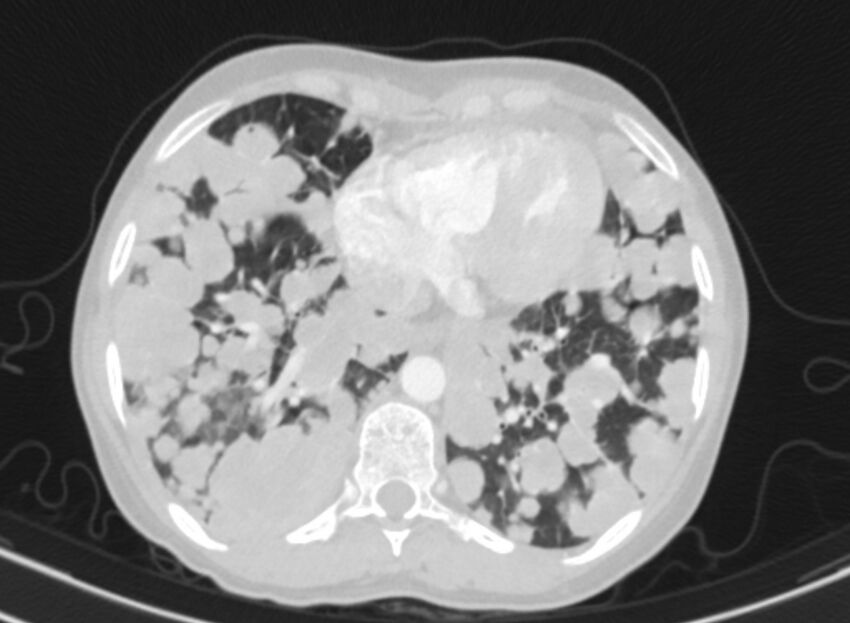 Cannonball metastases from breast cancer (Radiopaedia 91024-108569 Axial lung window 74).jpg