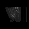 Carcinoma cervix- brachytherapy applicator (Radiopaedia 33135-34173 Sagittal bone window 115).jpg