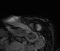 Cardiac amyloidosis (Radiopaedia 39736-42124 F 19).jpg