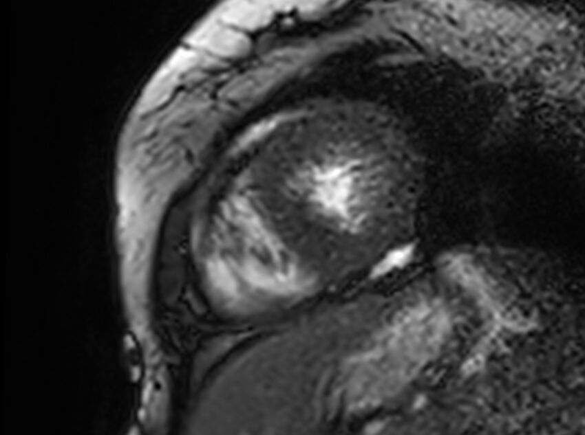 Cardiac amyloidosis (Radiopaedia 61600-69579 Short axis bSSFP 63).jpg