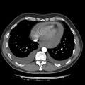 Cardiac tamponade (Radiopaedia 78607-91368 Axial C+ CTPA 66).jpg