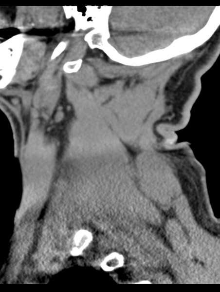 File:Cavernoma of cervical cord (Radiopaedia 50838-56346 B 14).png
