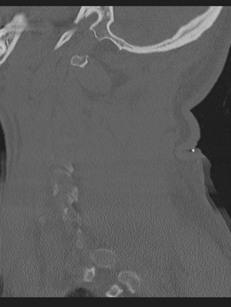 File:Cavernoma of cervical cord (Radiopaedia 50838-56346 Sagittal bone window 64).png