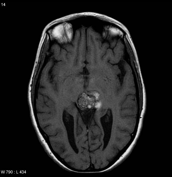 File:Cavernous malformation of the midbrain (Radiopaedia 7791-8615 Axial T1 3).jpg