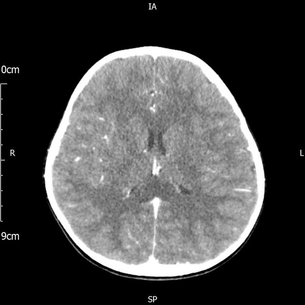 File:Cavernous sinus thrombosis (Radiopaedia 79414-92510 Axial Brain 117).jpg