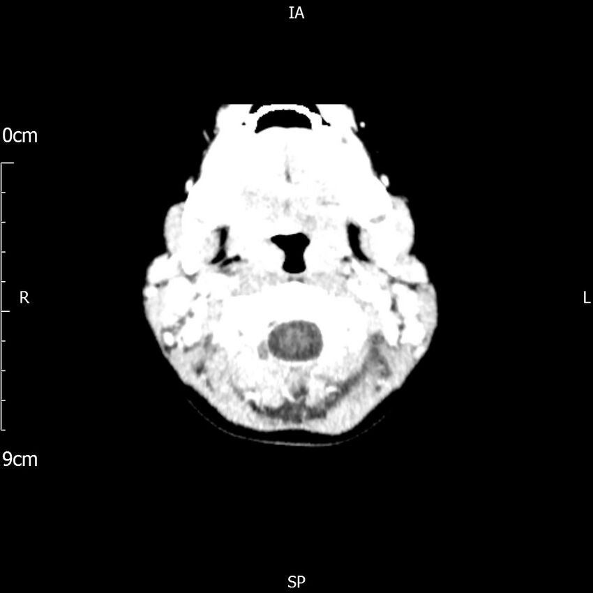 Cavernous sinus thrombosis (Radiopaedia 79414-92510 Axial Brain 27).jpg