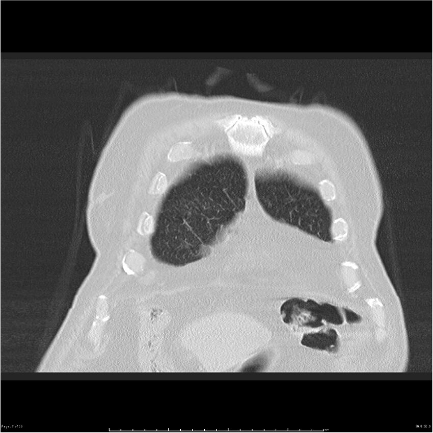Cavitating left lower lobe lesion - squamous cell lung cancer (Radiopaedia 27749-28176 Coronal lung window 7).jpg
