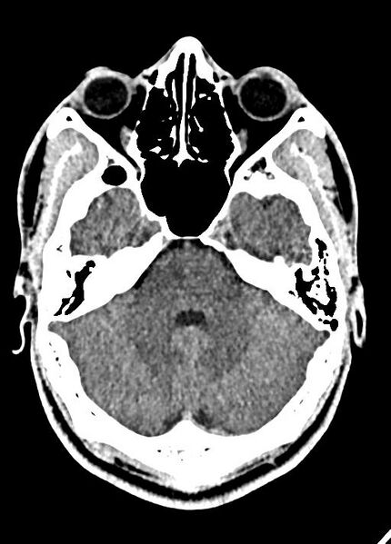 File:Cavum septum pellucidum and cavum vergae (Radiopaedia 77797-90060 Axial Brain Window 29).jpg