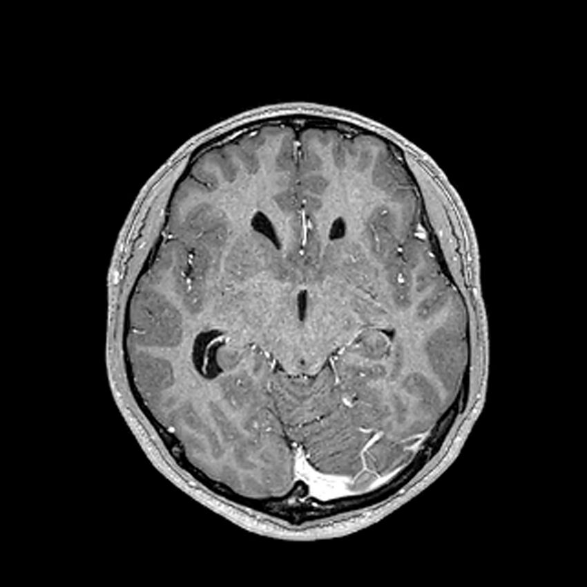 Central neurocytoma (Radiopaedia 79320-92380 Axial T1 C+ 111).jpg