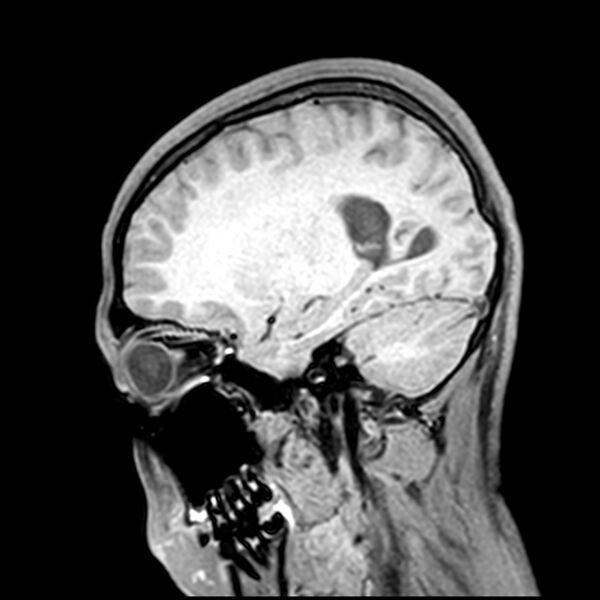 File:Central neurocytoma (Radiopaedia 79320-92380 Sagittal T1 87).jpg