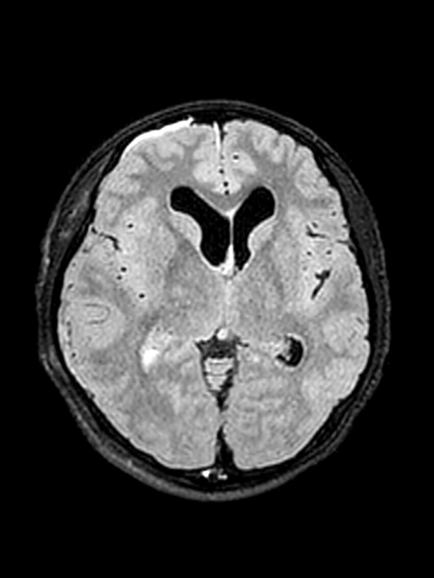 Central neurocytoma (Radiopaedia 79320-92381 Axial FLAIR 92).jpg
