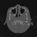 Cerebellar abscess secondary to mastoiditis (Radiopaedia 26284-26413 Axial bone window 13).jpg