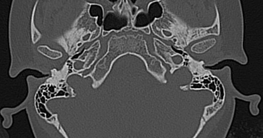 Cerebellopontine angle lipoma (Radiopaedia 57303-64242 Axial bone window 11).jpg