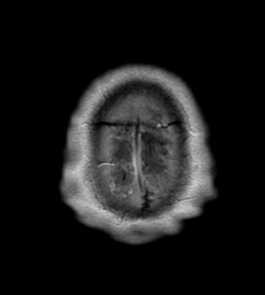File:Cerebellopontine angle meningioma (Radiopaedia 24459-24764 Axial T1 C+ 24).jpg