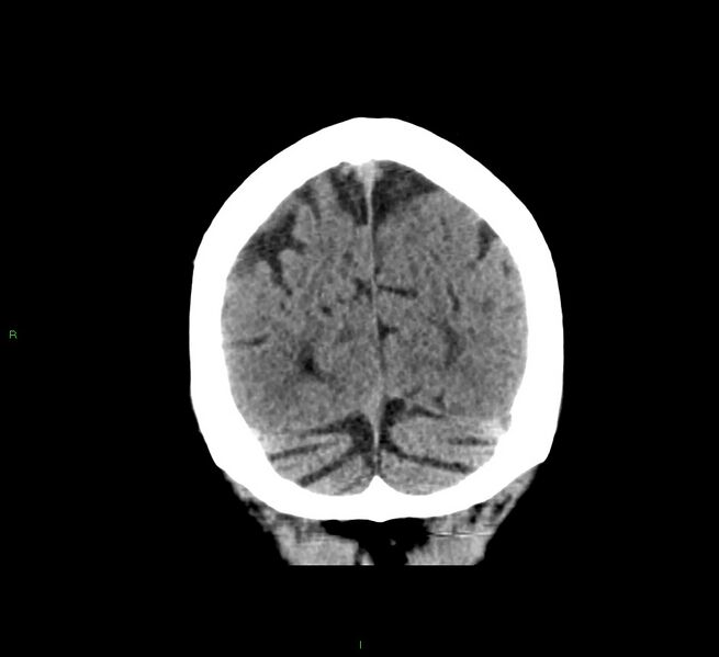 File:Cerebral amyloid angiopathy-associated lobar intracerebral hemorrhage (Radiopaedia 58376-65511 Coronal non-contrast 14).jpg