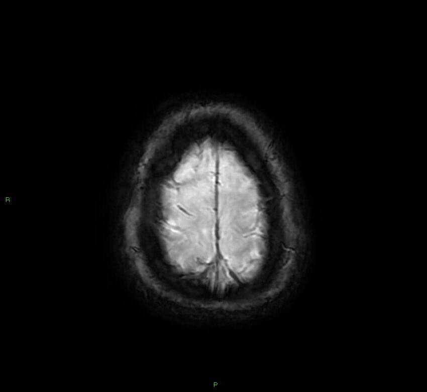 Cerebral amyloid angiopathy-associated lobar intracerebral hemorrhage (Radiopaedia 58378-65517 Axial SWI 67).jpg