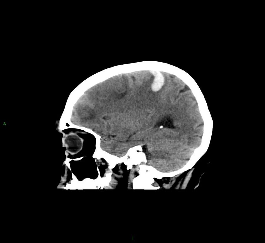 Cerebral amyloid angiopathy-associated lobar intracerebral hemorrhage (Radiopaedia 58529-65681 B 34).jpg