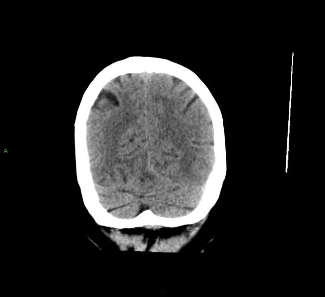 File:Cerebral amyloid angiopathy-associated lobar intracerebral hemorrhage (Radiopaedia 58529-65681 Coronal non-contrast 15).jpg